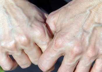 Fakta Unik: Ini Alasan Ilmiah Mengapa Pembuluh Darah Tampak Berwarna Biru